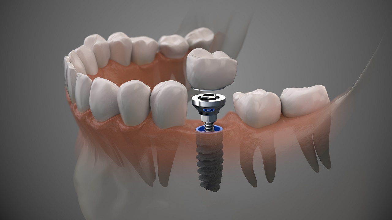 Problemy z zębami – dlaczego warto rozważyć implanty stomatologiczne?