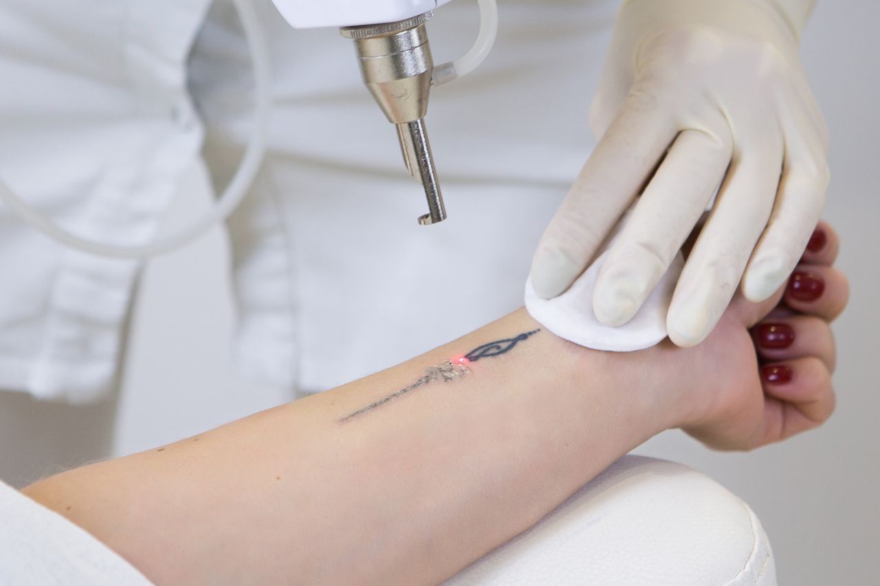 Jak wygląda laserowe usuwanie tatuażu?